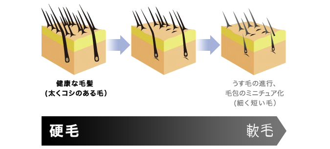 男性型脱毛(AGA)における発毛の変化