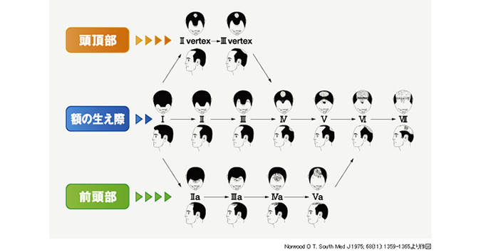 男性型脱毛(AGA)の診断と分類